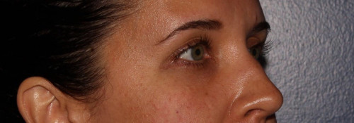 Versa – tear troughs after photo. Individual results may vary.