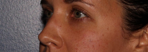 Versa – tear troughs after photo. Individual results may vary.