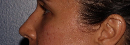 Versa – tear troughs after photo. Individual results may vary.
