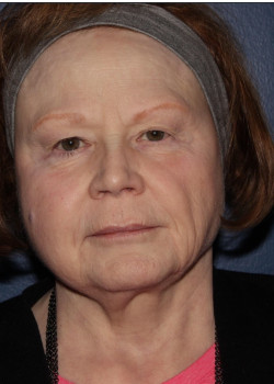 BBL Forever Young – full face after photo. Individual results may vary.