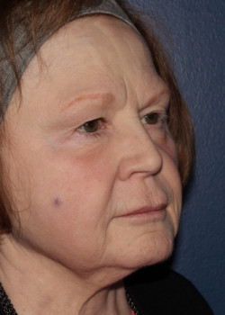 BBL Forever Young – full face after photo. Individual results may vary.