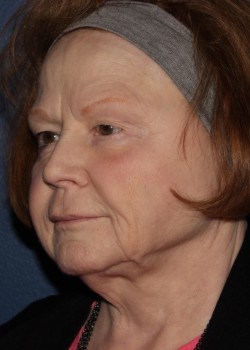 BBL Forever Young – full face after photo. Individual results may vary.