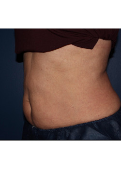 Coolsculpting – abdomen and flanks after photo. Individual results may vary.