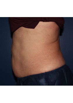 Coolsculpting – abdomen and flanks after photo. Individual results may vary.