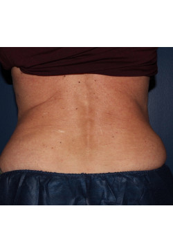 Coolsculpting – abdomen and flanks after photo. Individual results may vary.