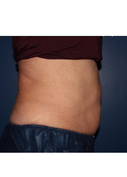 Coolsculpting – abdomen and flanks after photo. Individual results may vary.