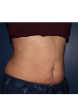 Coolsculpting – abdomen and flanks after photo. Individual results may vary.