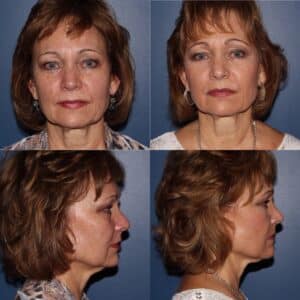 Bellafill Before & After Photos | Musick Dermatology, LLC