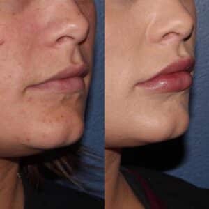 Juvederm Before & After Photos | Musick Dermatology, LLC