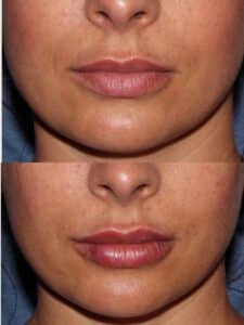 Juvederm Before & After Photos | Musick Dermatology, LLC