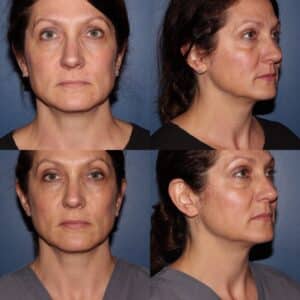 BELOTERO BALANCE® before and after photos | Musick Dermatology, LLC 
