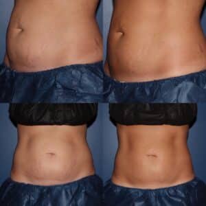 CoolSculpting Before & After Photos | Musick Dermatology, LLC Swansea IL CoolSculpting Before & After Photos | Musick Dermatology, LLC Swansea IL