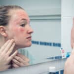 Eczema — Hard to Spell, Itchy to Have | Musick Dermatology, LLC