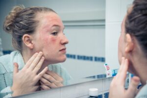 Eczema — Hard to Spell, Itchy to Have | Musick Dermatology, LLC