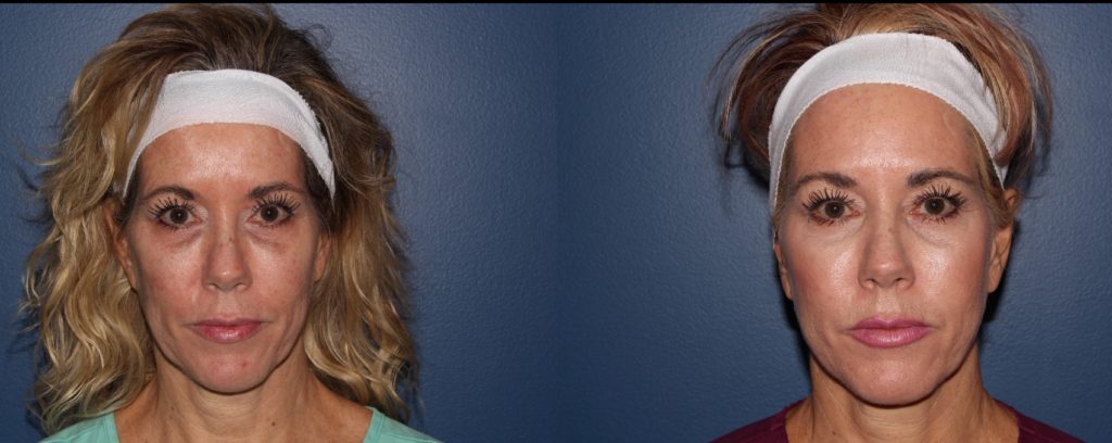 bellafill derma filler swansea IL musick dermatology
