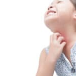 Eczema Treatment Swansea IL