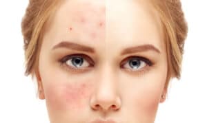 Hydrafacial | Swansea IL
