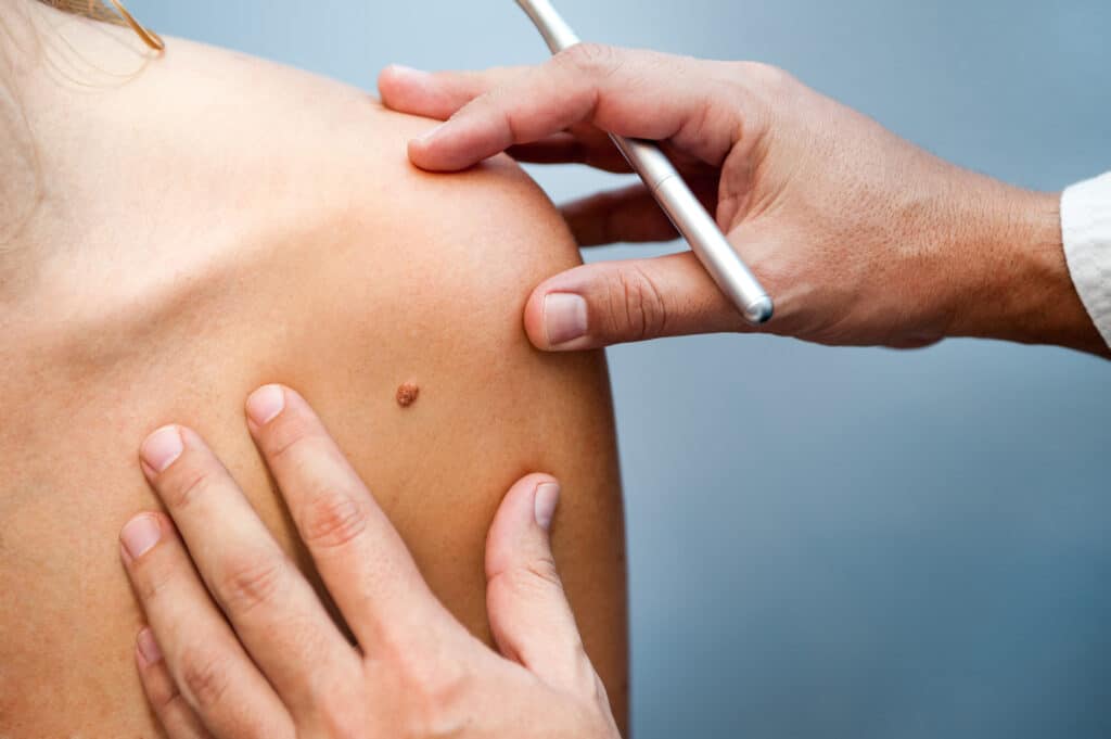 Skin Cancer Treatment | Swansea IL 