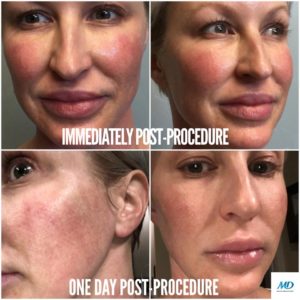 Secret RF Treatment | Microneedling | IL