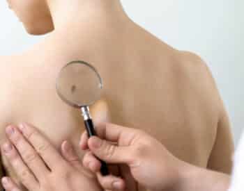 Moles Removal Swansea IL | Mole Treatment St. Louis