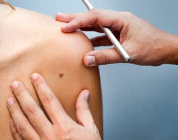 Mole Removal Swansea IL | Mole Treatment St. Louis MO | Nevus