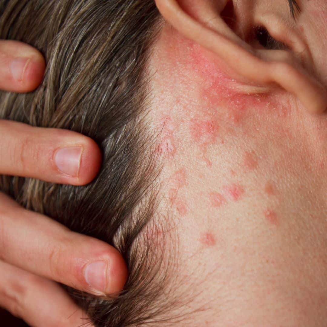 Vitamin D And Seasonal Skin Changes