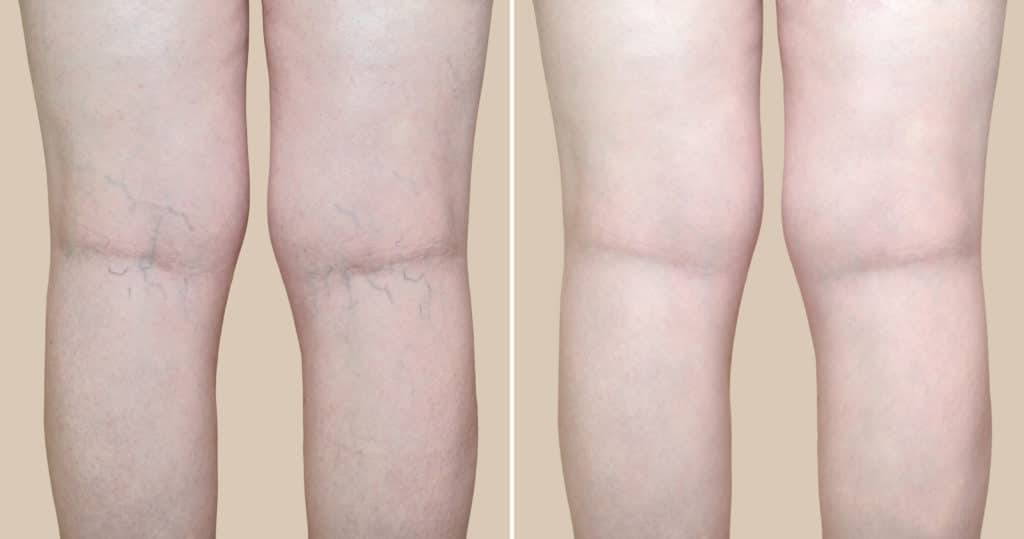 Legs of a woman with varicose veins and capillaries before and after medical treatment