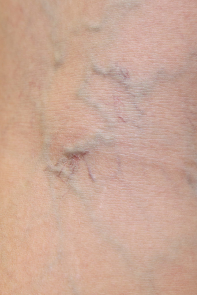 close-up on varicose veins on the skin