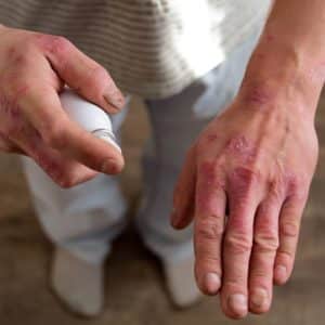 E is for Eczema