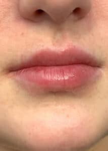 juvederm after