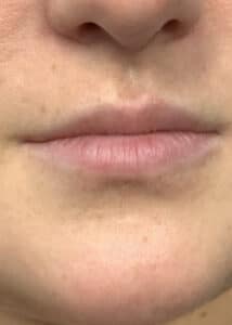 juvederm before