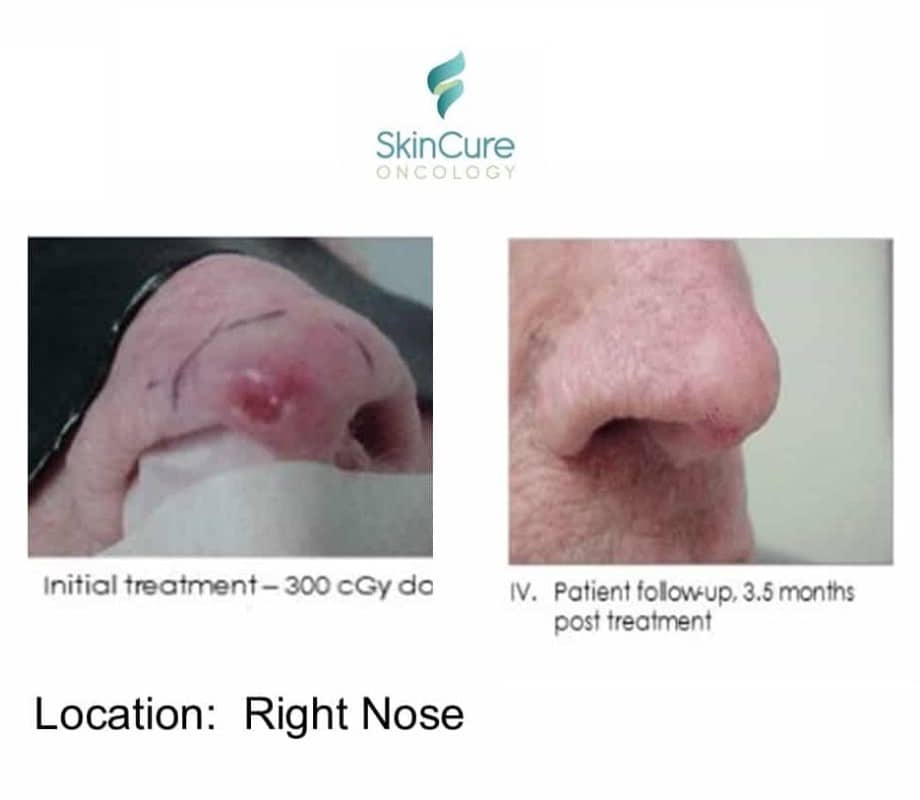 two small before and after photos of someone's nose after SRT skin cancer treatment, surrounded by text explaining the photograph with details on the procedure