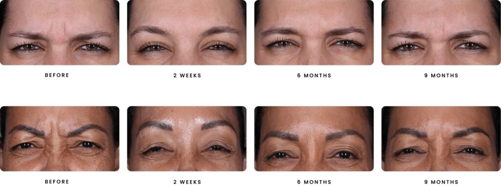 DAXXIFY Treatment Swansea IL DAXXIFY Treatment Swansea IL