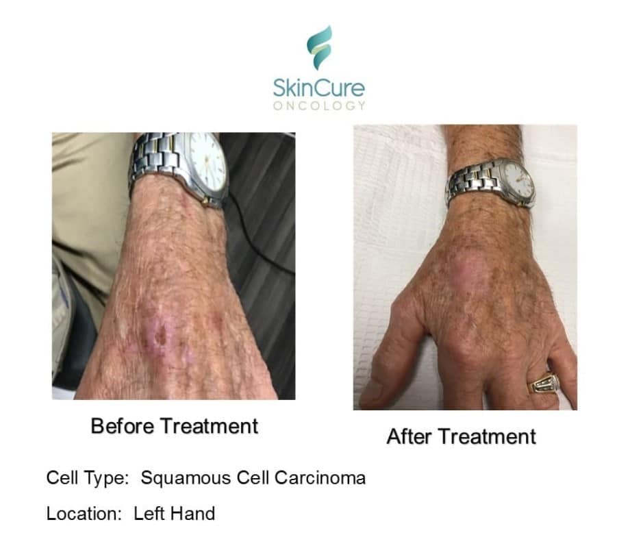 older patient’s hand with carcinoma before and after superficial radiation therapy