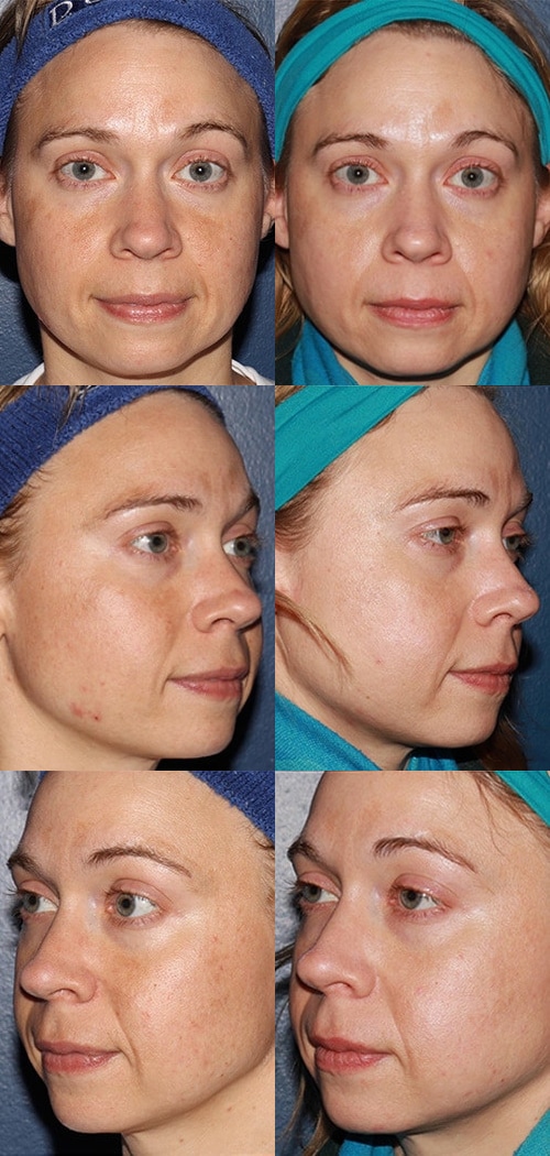 woman’s face from different angles before and after halo laser treatment, skin clearer after