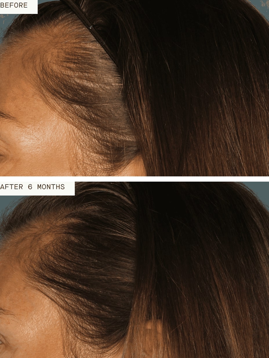 woman before and after Nutrafol Vitamins - much fuller hair after treatment
