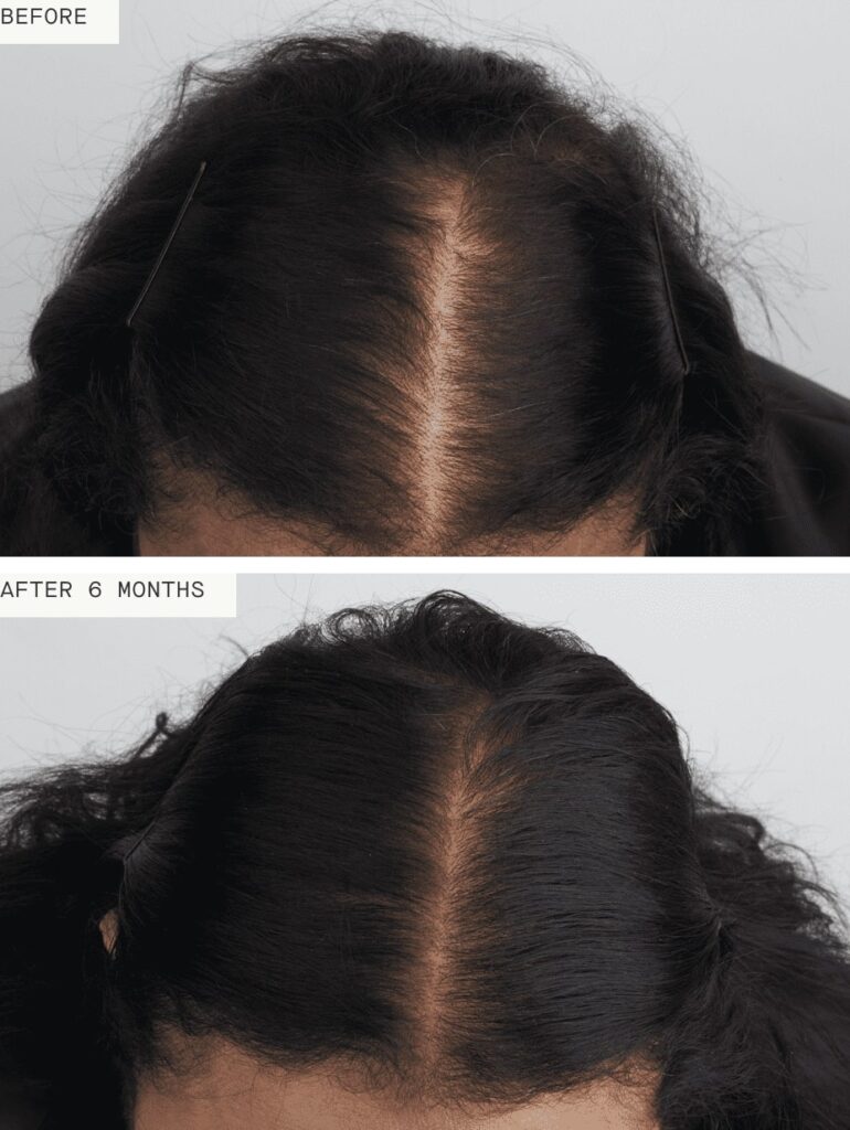 Nutrafol Womens Balance Amanda Before After Nutrafol Womens Balance Amanda Before After