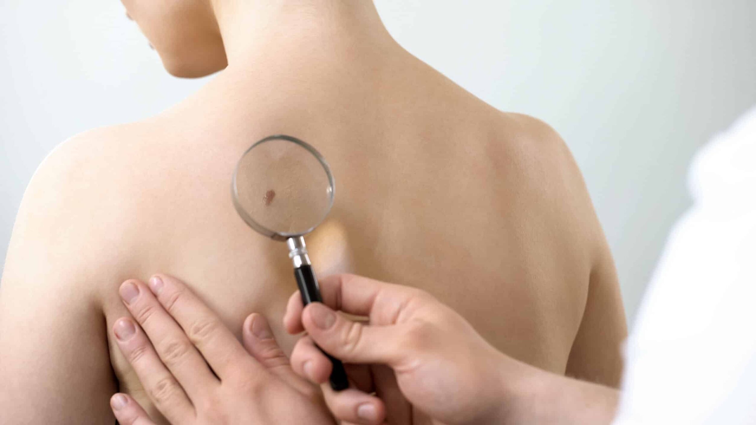 Dermatologist checking mole through magnifying glass, skin cancer prevention