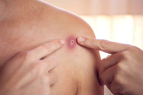 Boils on skin discount