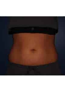 CoolSculpting