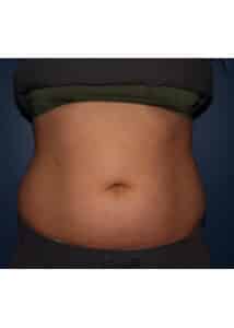 CoolSculpting