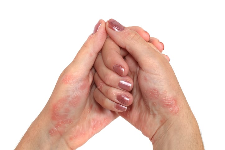 Psoriasis Hand