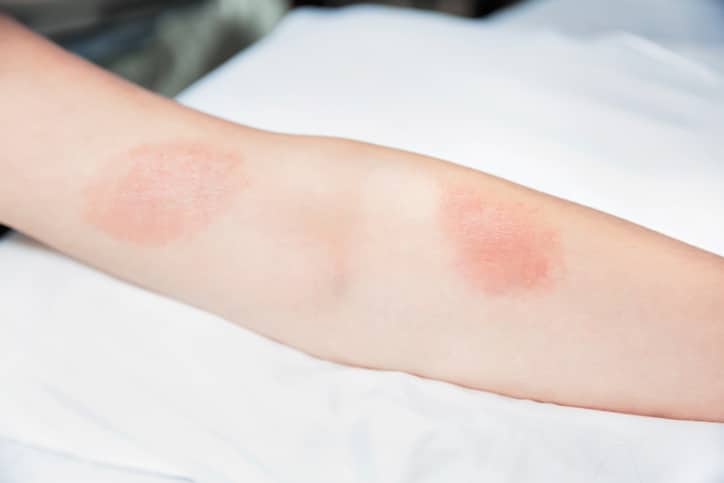 Poison ivy on arm deals