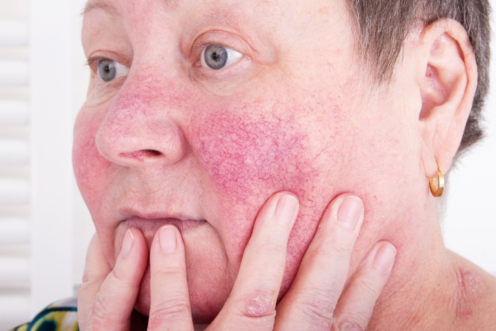 Rosacea, facial skin disorder, portrait of unhappy elderly woman