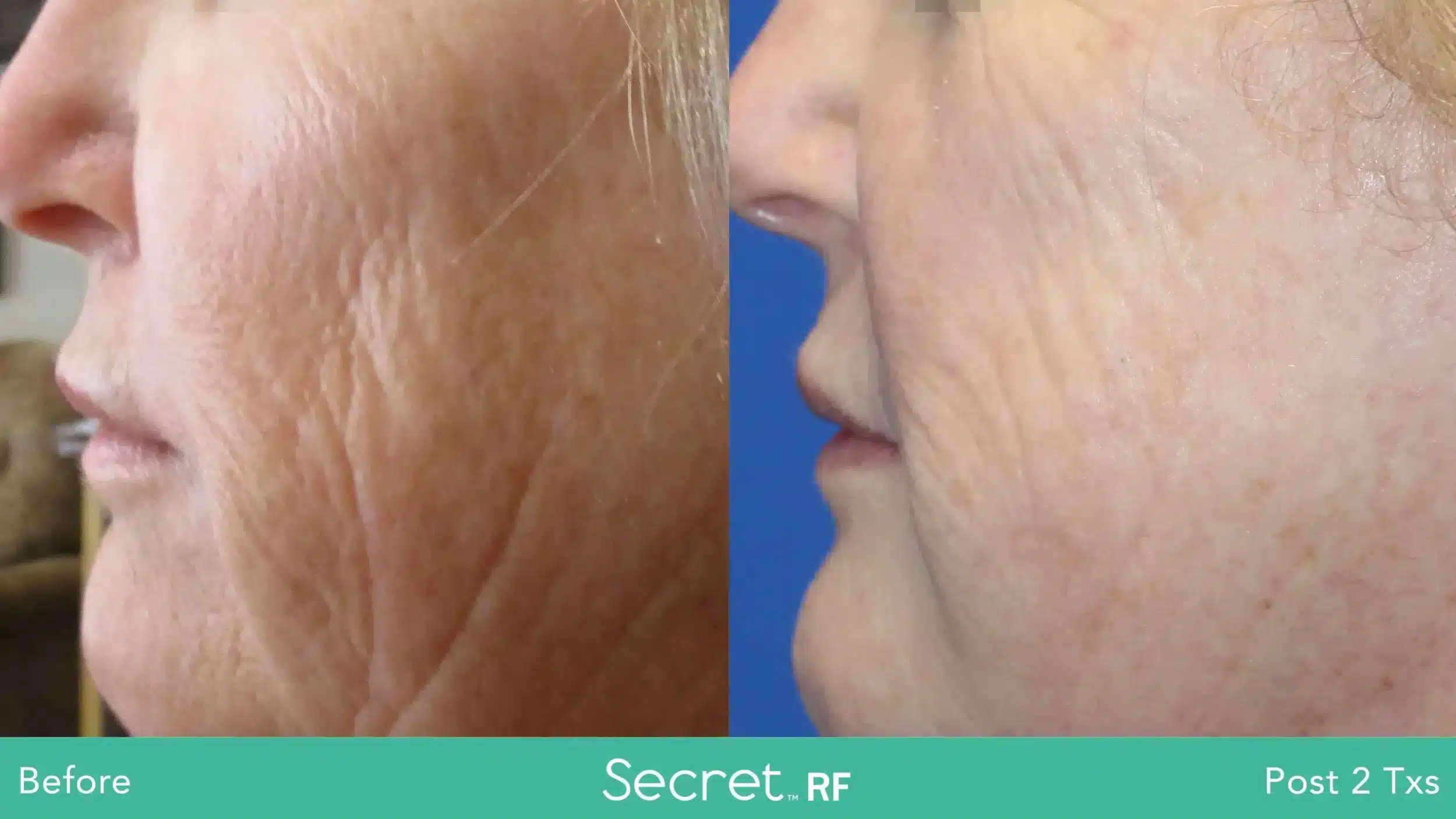 Before and After Secret Radio Frequency Microneedling in Swansea IL Before and After Secret Radio Frequency Microneedling in Swansea IL