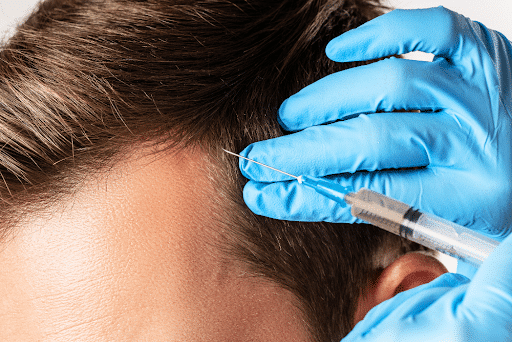 PRP for hair loss