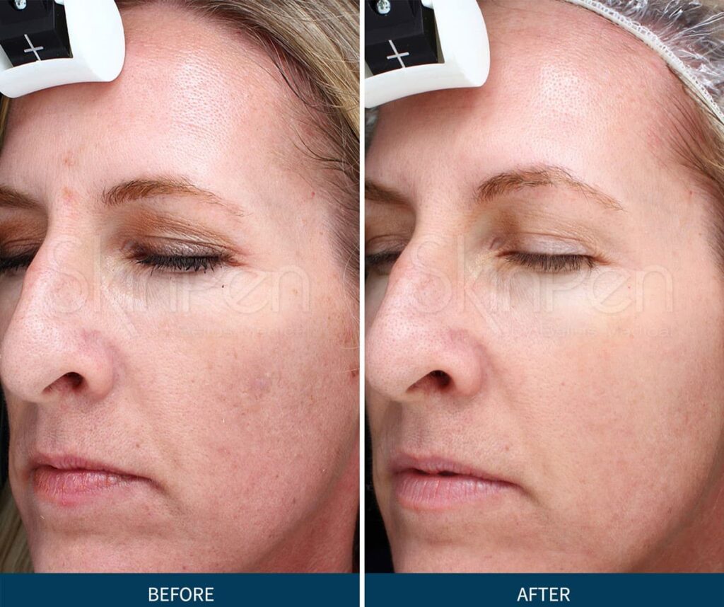 Before and After Microneedling Swansea IL Before and After Microneedling Swansea IL