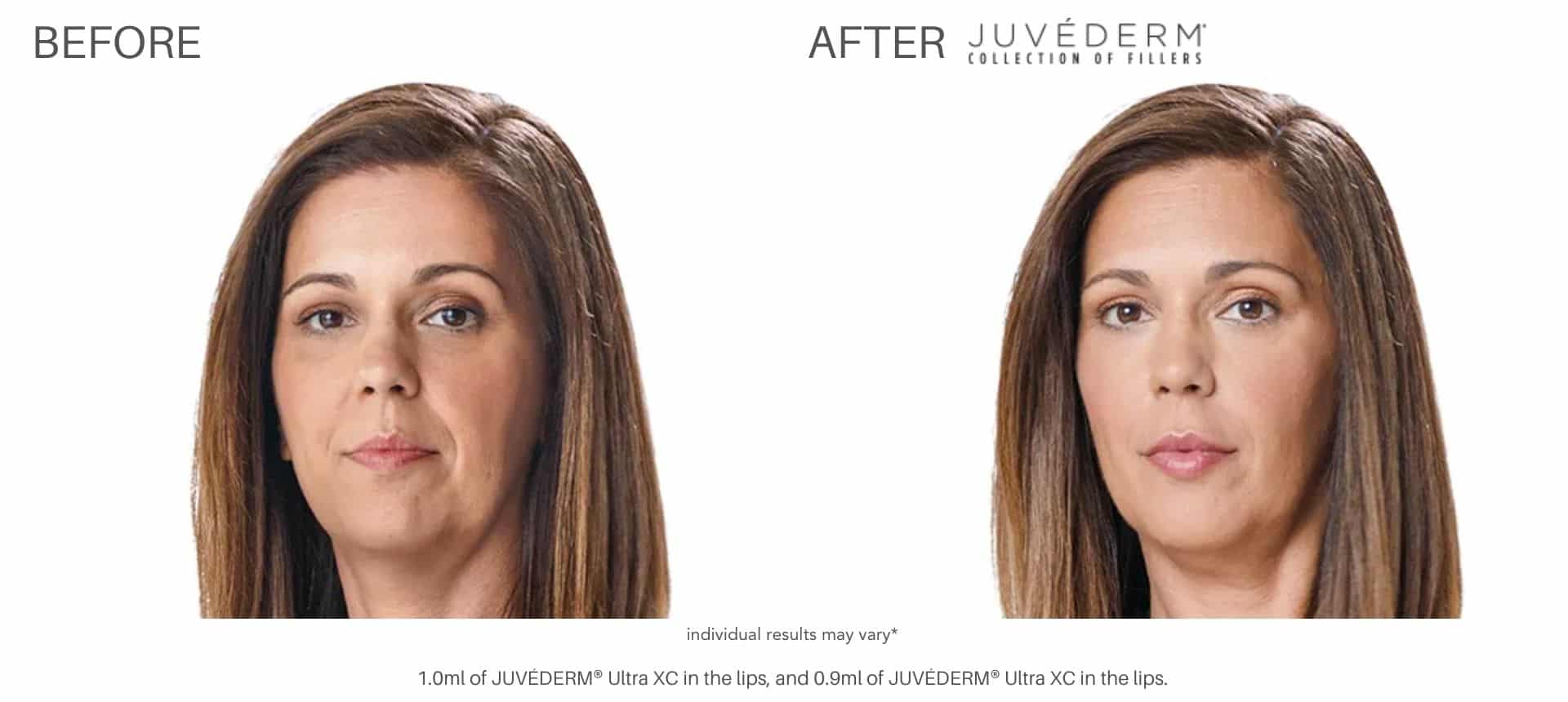 juvderm before and after pics numa spa 1