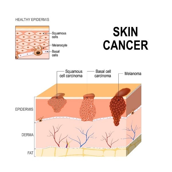 skin cancer 2022