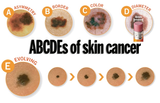 skin cancer